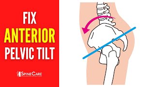 How to Fix Your Anterior Pelvic Tilt  STEPBYSTEP Guide [upl. by Idnib]