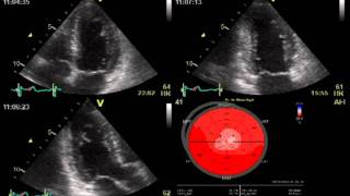 SPECKLE TRACKING ECHOCARDIOGRAPHY  HEART FUNCTION [upl. by Nnaj]