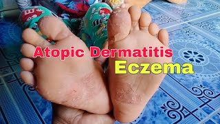 Eczema Atopic Dermatitis Skin Ashma  Hika sa Balat [upl. by Epillihp332]