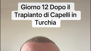 Trapianto di Capelli Giorno 12  Progressi e Cura PostTrapianto 💇‍♂️ [upl. by Server]