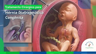 Hérnia Diafragmática Congênita  Dr Mauricio Calderon [upl. by Ahsyle617]