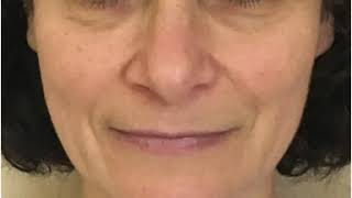 Facelift Contouring pre e post Lifting Prima e Dopo Dott Antonio Distefano [upl. by Noirod]