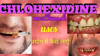 Chlorhexidine mouthwash  Listerine mouthwash  Hexidine mouthwash Uses how to use [upl. by Edla]