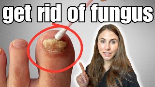 Get Rid Of Toenail Fungus With These 4 Easy Home Remedies [upl. by Eenaej456]