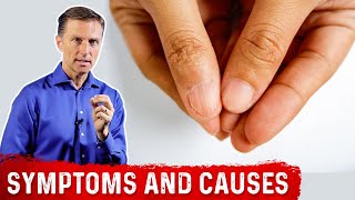 Iron Deficiency Symptoms and Causes of Anemia – DrBerg [upl. by Anivol]