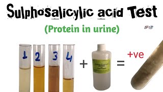 Sulphosalicylic acid test for albumin in urine [upl. by Carpio]