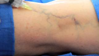 Surface Sclerotherapy at VēNA Clinic [upl. by Burta]