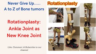 Rotationplasty Reversed Ankle Joint working as New Knee Joint [upl. by Creedon]