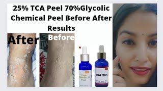 25 TCA peel 70 Glycolic peel Before After Results HandLegsBody Chemical peelIn Hindi [upl. by Huskey]