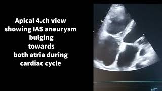 IAS aneurysm [upl. by Alatea]