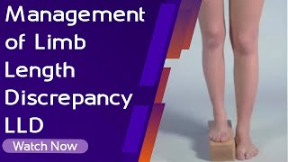 Management of Limb Length Discrepancy LLD  Orthopaedic Academy [upl. by Euqinommod]