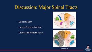 Traumatic Brown Sequard Syndrome A Review of Anatomy and Imaging [upl. by Ennadroj]