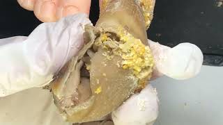 Very Long Onychomycosis That Hasn’T Been Trimmed In More Than A Year 1107zenipV4345【ItasChannel】 [upl. by Atilrak]