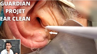 GUARDIAN PROJET Ear Irrigation Ear Wax Removal [upl. by Psyche662]