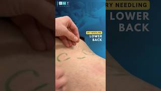 Relieve Lower Back Pain using Dry Needling osteopathy manualtherapy acupuncture backpain [upl. by Hanfurd]