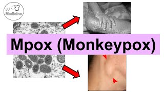 Mpox Monkeypox  Transmission Pathophysiology Signs amp Symptoms Diagnosis Treatment [upl. by Etac]