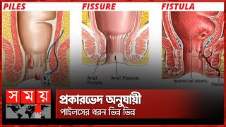 পাইলস ফিসার ও ফিস্টুলার মধ্যে পার্থক্য কী  Piles  Fissure  Fistula  Somoy TV [upl. by Ahsiki662]