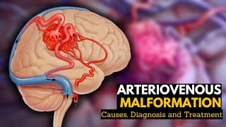 Arteriovenous Malformation Causes Signs and Symptoms Diagnosis and Treatment [upl. by Ileak]