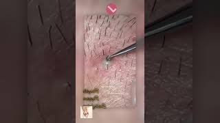 Blackheads Removal  Acne Treatment and Very Satisfying Satisfying Pimple pop blackheads [upl. by Isaak]