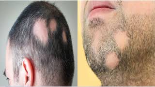 Alopecia Areata Causes And Treatment ಈ ರೀತಿಯ ಸಮಸ್ಯೆಗಳು ನಿಮಗೂ ಇದಿಯೇ ಹಾಗಿದ್ದರೆ ಈ ವಿಡಿಯೋ ನೋಡಿ [upl. by Maltzman]