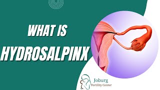 WHAT IS HYDROSALPINX [upl. by Henleigh84]