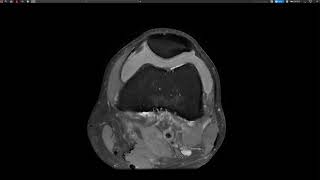 Knee injury LCL Bursa [upl. by Enyr359]