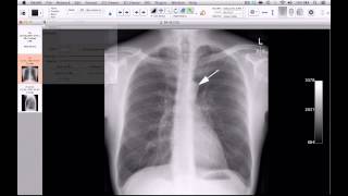 How to create anatomy teaching sets using OsiriX [upl. by Elayor]