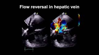 EchoWeb  Left Ventricular Akinesis [upl. by Chloris]