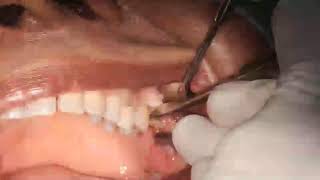 Live  grossly decayed second molar extraction by drcmurugavel [upl. by Anailuy]