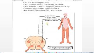 13 ALS amp Brown Sequard syndrome [upl. by Dorman]