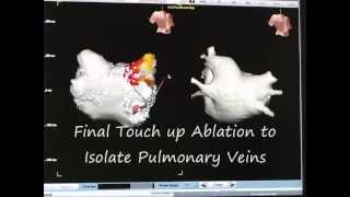 Atrial Fibrillation Ablation part 3 of 3 How to Perform Pulmonary Vein Isolation [upl. by Lanod]