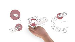 Zahnersatz – Teilprothesen oder Vollprothesen richtig einsetzen und rausnehmen 2016 [upl. by Etnaid774]