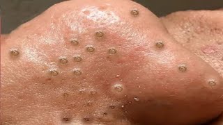 Big Cystic Acne Blackheads Extraction Blackheads amp Milia Whiteheads Removal Pimple Popping  3692 [upl. by Aryn300]