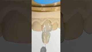 Central Amber Press Veneer EnvisiontecMain envisiontec lsk121shorts dental teeth [upl. by Yerxa]