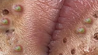 Big Cystic Acne Blackheads Extraction Blackheads amp Milia Whiteheads Removal Pimple Popping  3699 [upl. by Eahcim]