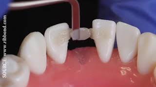 Ribbond Single Visit Bridge Technique  Single visit Teeth [upl. by Wald]