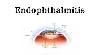 ENDOPHTHALMITIS Explained in 2 minutes [upl. by Milburn]