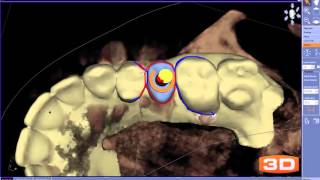 Edentulous Site 13 [upl. by Chip]