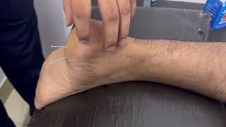 Heel Pain Treatment by Dry Needling Therapy  Full video [upl. by Lorrimer]