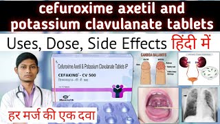 cefuroxime axetil and potassium clavulanate tablets  cefakind cv 500 mg tablet uses in hindi [upl. by Kcirted]