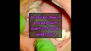 Don’t Cut Your Wires Out if Your Jaw is Locked Shut [upl. by Bathsheba]