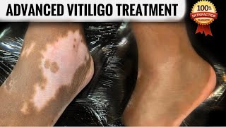 Latest technique for treating a vitiligo whitepatch  No tablets [upl. by Harday673]