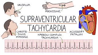 Understanding Supraventricular Tachycardia SVT [upl. by Yhotmit54]