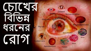 চোখের বিভিন্ন ধরনের রোগ এবং তাদের লক্ষণ16 type of Eye Diseases [upl. by Eatnuahs]