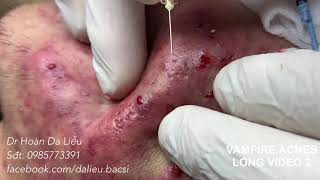 Dermatologistsqueeze pimpleswhitehead blackhead pustuleanti acnesVimpire acnes long video 2 [upl. by Birchard]