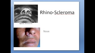 ENT RhinoScleroma Klebsiella Granulomatous disease nose woody Mikulicz Frisch Russell [upl. by Lemmueu836]