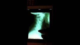 PostureScreen Mobile Upgrade Video Subluxation Degeneration [upl. by Elisa]