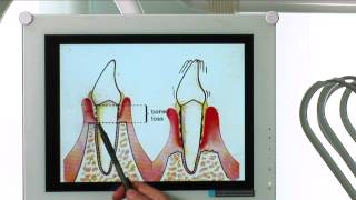 Diagnosi e cura per la piorrea o malattia parodontale [upl. by Adhamh]