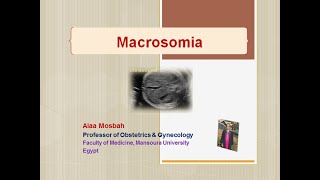 Macrosomia [upl. by Shoemaker932]