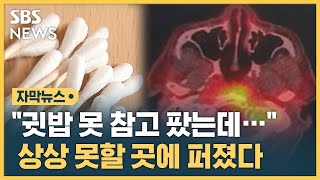 quot귓밥 못 참고 팠는데…quot 상상 못할 곳에 퍼졌다 자막뉴스  SBS [upl. by Ajit]